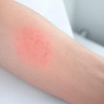 Circular Rash Circular Rash