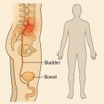 loss of bladder or bowel control