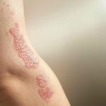 Cracked or Bleeding Skin