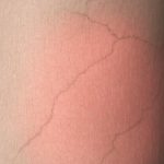 Cracks or Tears in the Skin