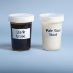 Dark Urine and Pale Stool
