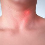 Enlarged Lymph Nodes Enlarged Lymph Nodes