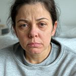 Fatigue due to interrupted sleep Fatigue due to interrupted sleep