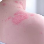 Red, Inflamed Skin