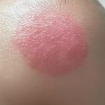 Scalp Psoriasis