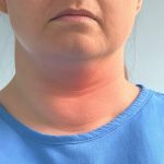 Swelling in the Neck (Goiter) Swelling in the Neck (Goiter)