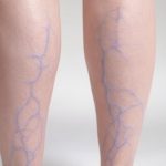 Visible Swollen Veins Visible Swollen Veins