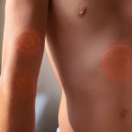 Numbness or tingling sensation in affected areas