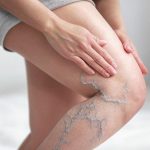itching or discomfort- varicose veins itching or discomfort- varicose veins