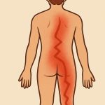 sciatica