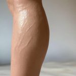swelling- varicose veins swelling- varicose veins